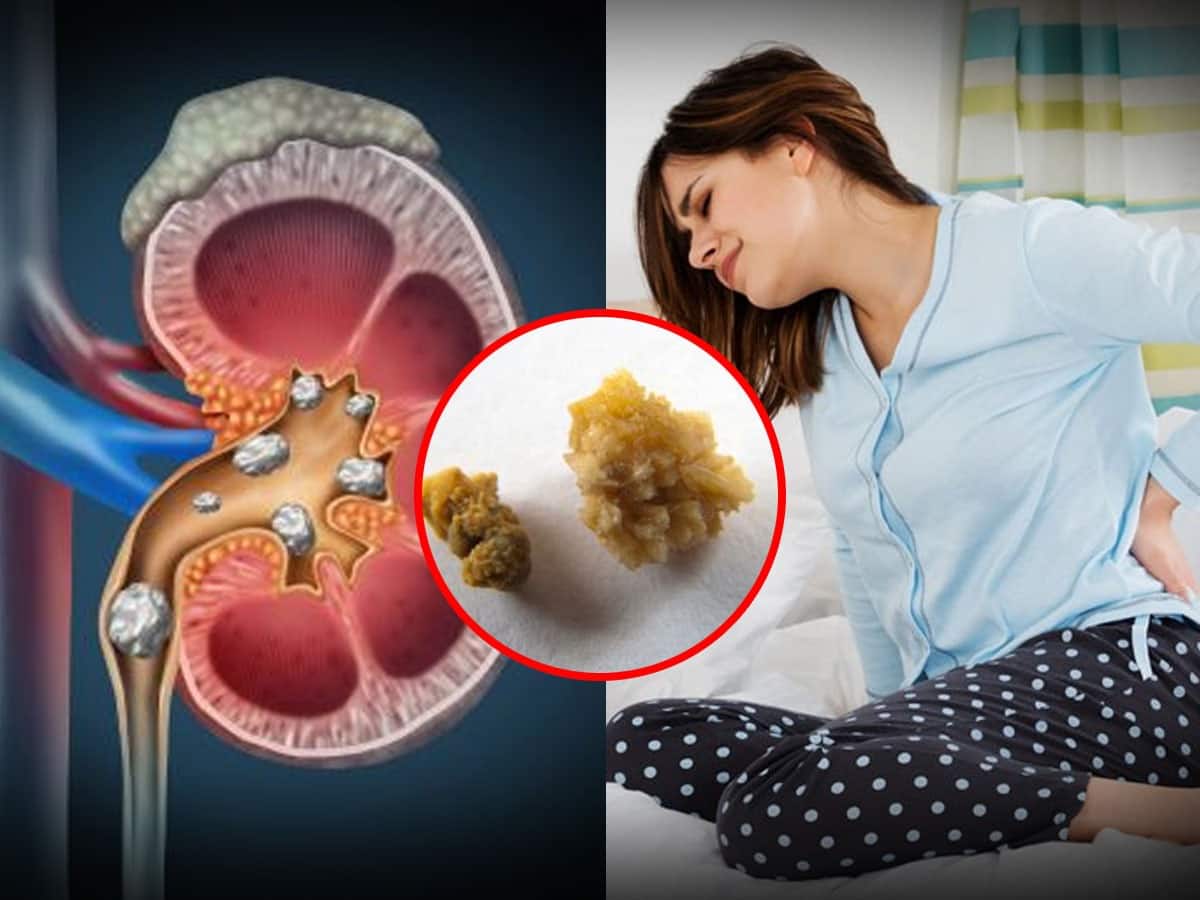 OTC Drugs And Home Remedies For Kidney Stones Could Do More Harm Than Good, Warns Doc